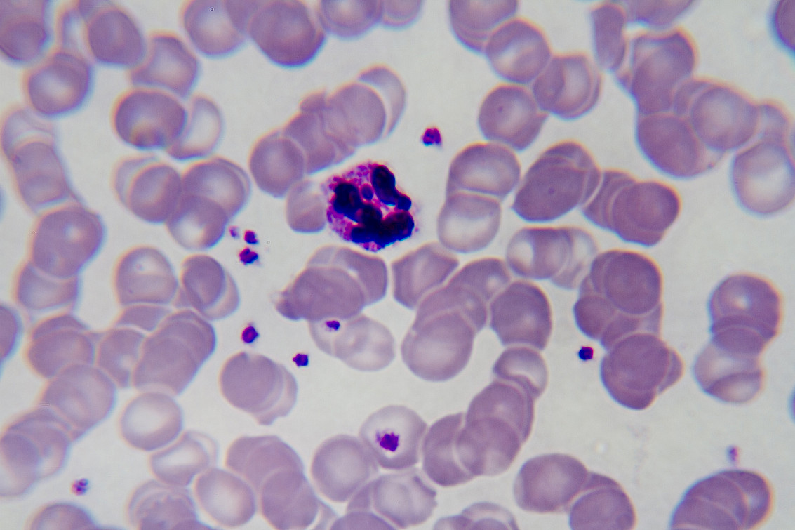 Plasmodium falciparum malaria in human blood