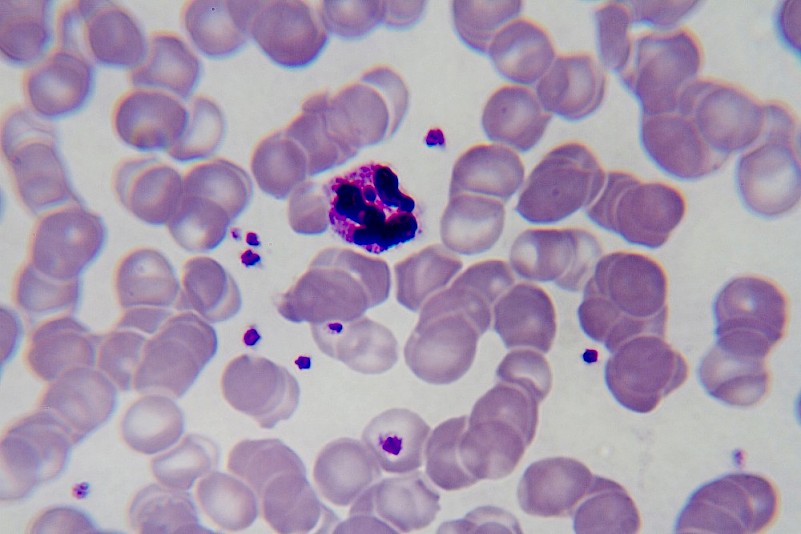 Pharmacogenomics data analysis identifying genetic vulnerabilities relevant to malaria treatment response.